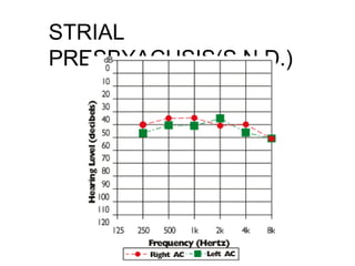 STRIAL
PRESBYACUSIS(S.N.D.)
 