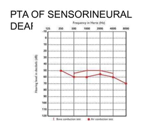 PTA OF SENSORINEURAL
DEAFNESS
 