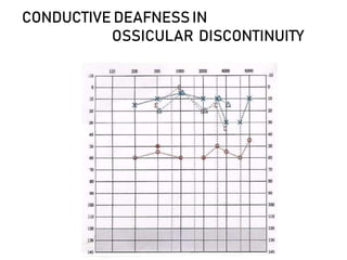 CONDUCTIVE DEAFNESS IN
OSSICULAR DISCONTINUITY
 