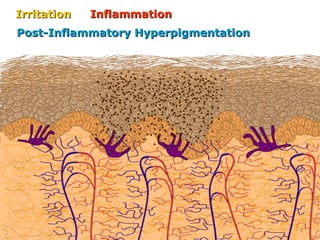 IrritationIrritation InflammationInflammation
Post-Inflammatory HyperpigmentationPost-Inflammatory Hyperpigmentation
 