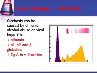 Liver damage - Cirrhosis
• Cirrhosis can be
caused by chronic
alcohol abuse or viral
hepatitis
• ↓ albumin
• ↓ α1, α2 and β
globulins
• ↑ Ig A in γ-fraction
 