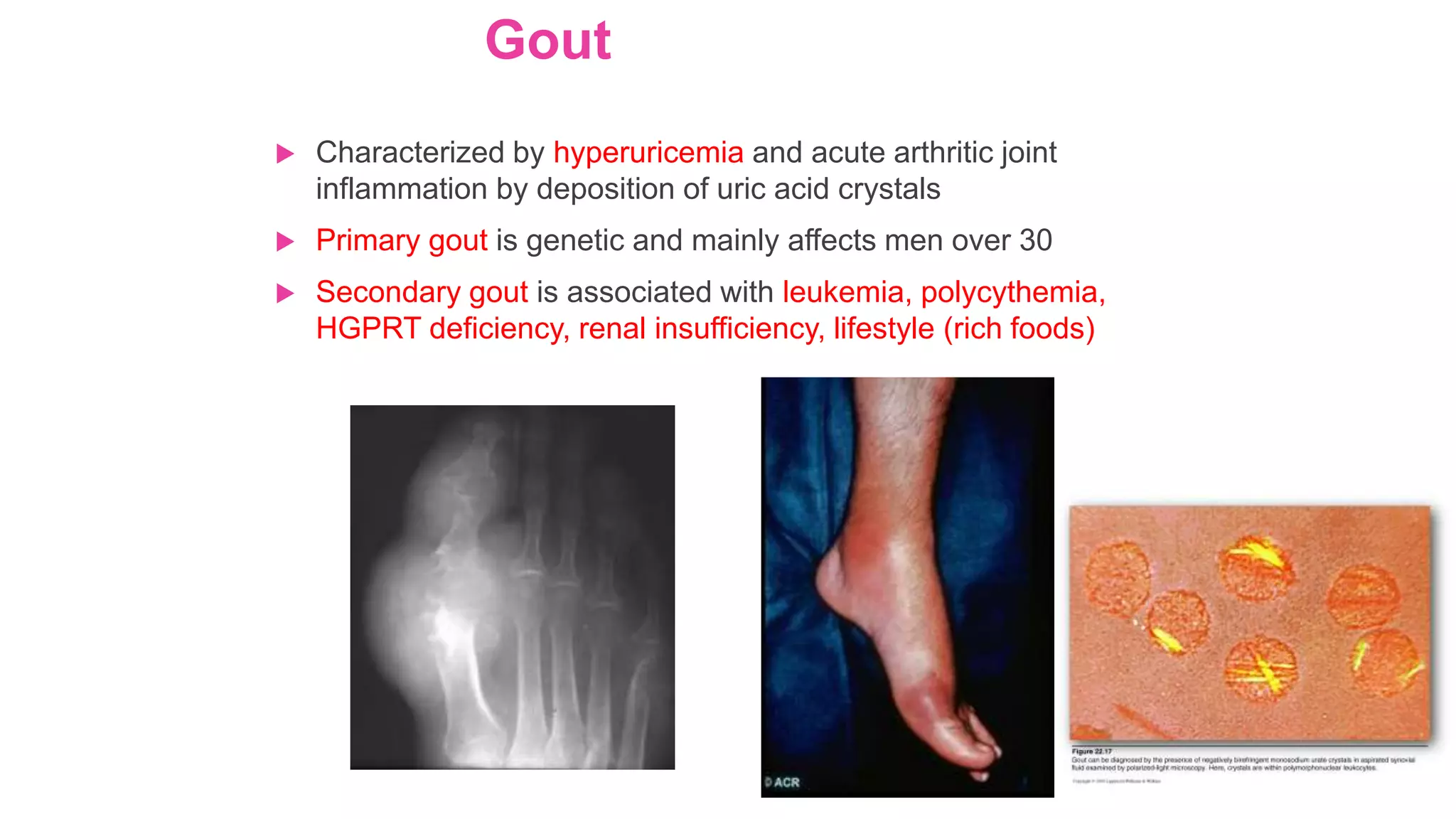 Gout
 Characterized by hyperuricemia and acute arthritic joint
inflammation by deposition of uric acid crystals
 Primary gout is genetic and mainly affects men over 30
 Secondary gout is associated with leukemia, polycythemia,
HGPRT deficiency, renal insufficiency, lifestyle (rich foods)
 