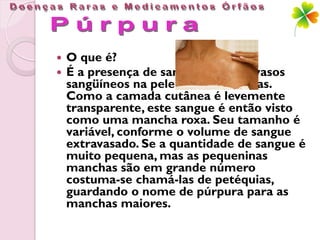   O que é?
   É a presença de sangue fora dos vasos
    sangüíneos na pele ou nas mucosas.
    Como a camada cutânea é levemente
    transparente, este sangue é então visto
    como uma mancha roxa. Seu tamanho é
    variável, conforme o volume de sangue
    extravasado. Se a quantidade de sangue é
    muito pequena, mas as pequeninas
    manchas são em grande número
    costuma-se chamá-las de petéquias,
    guardando o nome de púrpura para as
    manchas maiores.
 