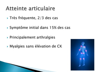  Très fréquente, 2/3 des cas
 Symptôme initial dans 15% des cas
 Principalement arthralgies
 Myalgies sans élévation de CK
 
