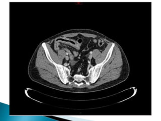  Urine : rapport protéine/créatinine normal
 Biopsie peau : vasculite leucocytoclasique
 Biologie : CRP 29 VS 20, bilan auto-immun
négatif (sauf FR 23)
 En 11/2016, douleurs crampoïdes +++
◦ CT-scan abdo : hématome de paroi secondaire à
purpura d’Henoch-Schönlein
 PET-CT : pas de néoplasie
 