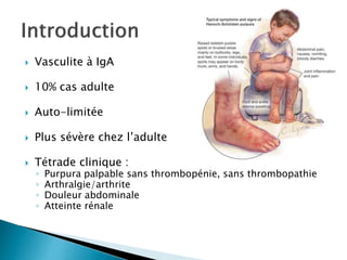  Vasculite à IgA
 10% cas adulte
 Auto-limitée
 Plus sévère chez l’adulte
 Tétrade clinique :
◦ Purpura palpable sans thrombopénie, sans thrombopathie
◦ Arthralgie/arthrite
◦ Douleur abdominale
◦ Atteinte rénale
 