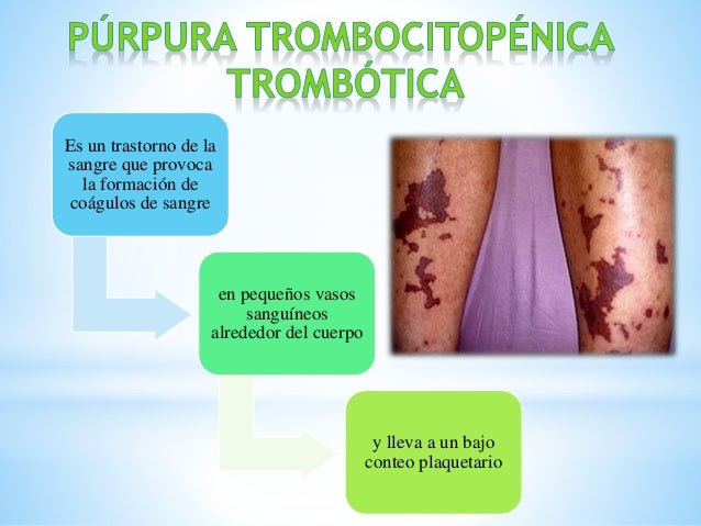 Purpura trombocitopenica