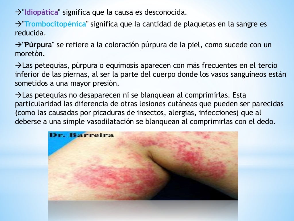Purpura trombocitopenica Purpura trombocitopenica