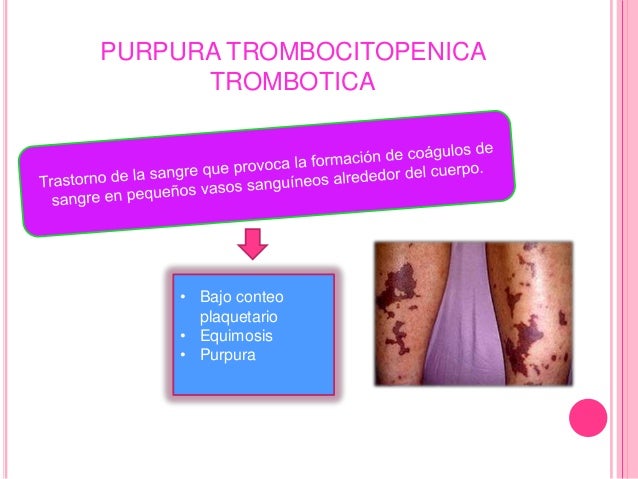 Purpura trombocitopenica (1)