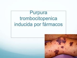 Purpura
trombocitopenica
inducida por fármacos
 
