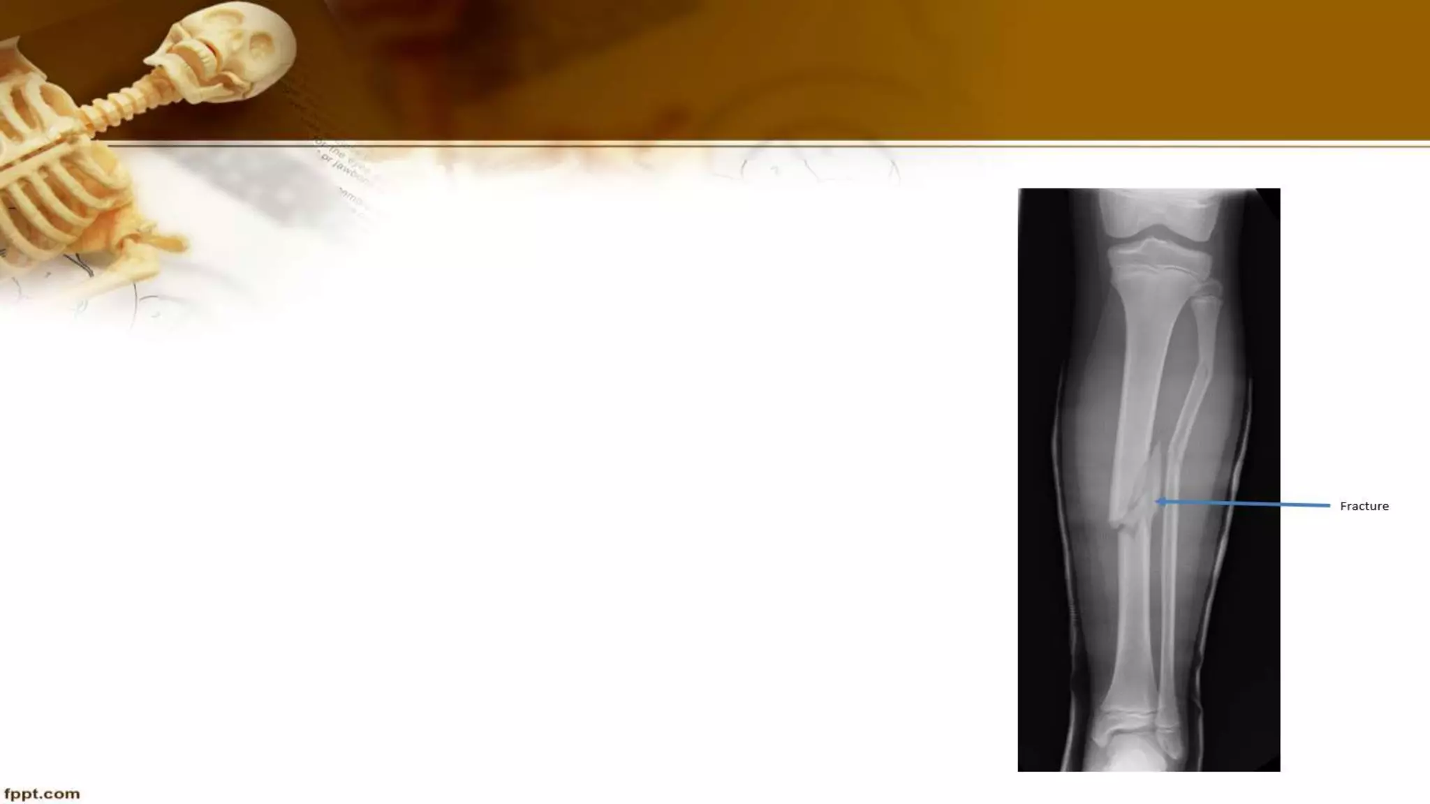 Purvi shah anatomy of tibia ppt