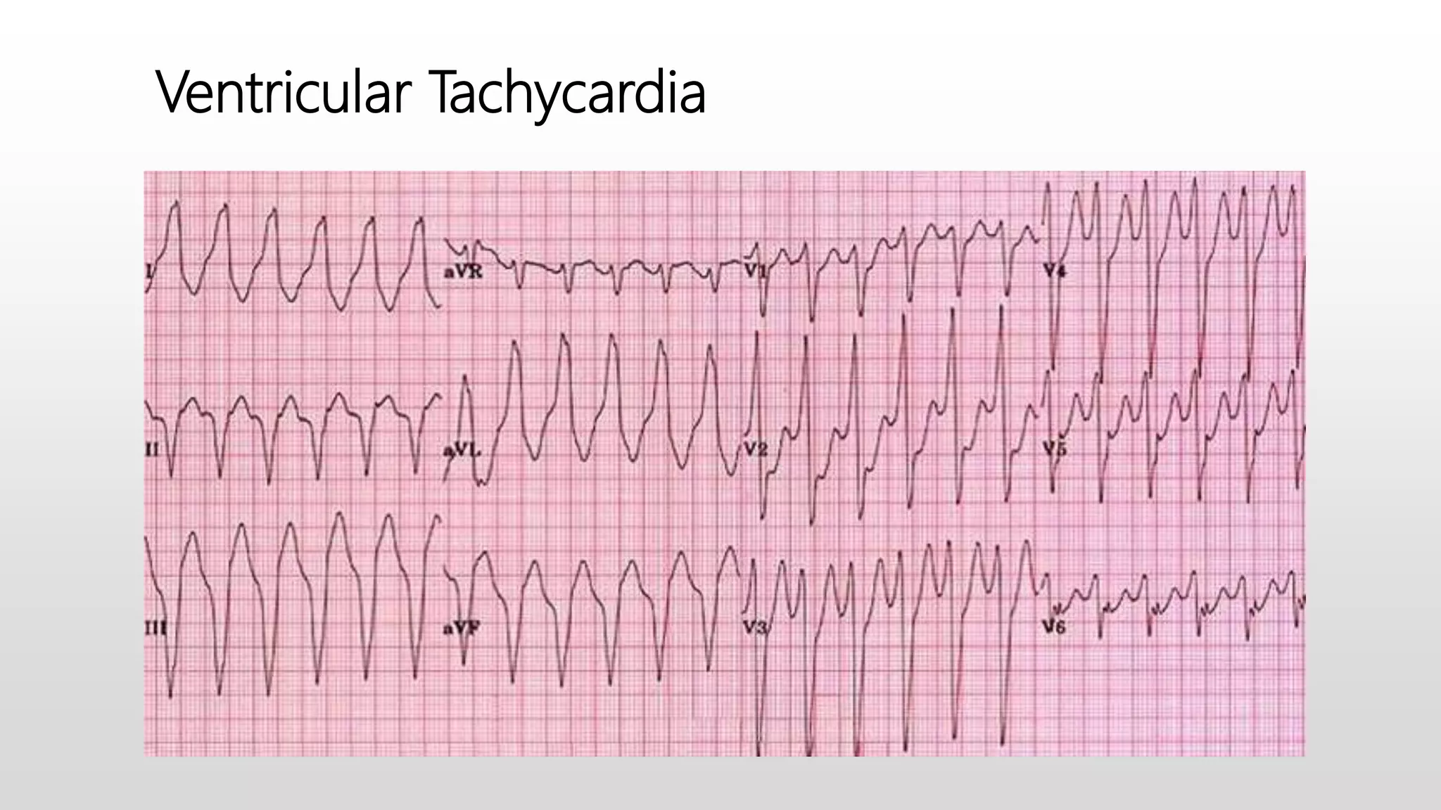 Ventricular Tachycardia
 