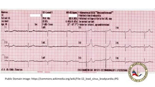 Public Domain Image: https://commons.wikimedia.org/wiki/File:12_lead_sinus_bradycardia.JPG
 