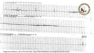 Image from Ed Burn, Life in the Fast Lane: http://lifeinthefastlane.com/ecg-library/sick-sinus/
 