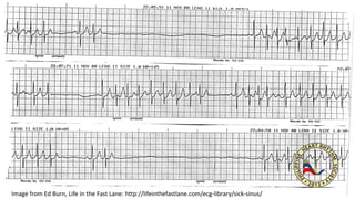 Image from Ed Burn, Life in the Fast Lane: http://lifeinthefastlane.com/ecg-library/sick-sinus/
 