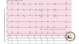 Sinoatrialexitblock:http://commons.wikimedia.org/wiki/User:Jer5150
 