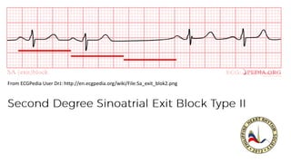 From ECGPedia User DrJ: http://en.ecgpedia.org/wiki/File:Sa_exit_blok2.png
 