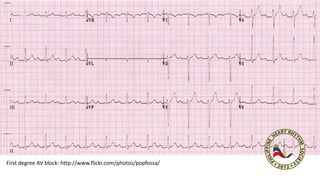 First degree AV block: http://www.flickr.com/photos/popfossa/
 