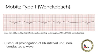 •
Image from Ed Burns: http://cdn.lifeinthefastlane.com/wp-content/uploads/2011/04/ECG_wenckebach.jpg
 