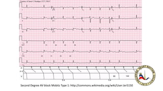 Second Degree AV block Mobitz Type 1: http://commons.wikimedia.org/wiki/User:Jer5150
 
