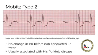 •
•
Image from Ed Burns: http://cdn.lifeinthefastlane.com/wp-content/uploads/2011/04/Mobitz_II.gif
 