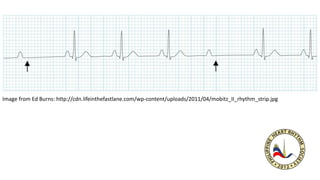 Image from Ed Burns: http://cdn.lifeinthefastlane.com/wp-content/uploads/2011/04/mobitz_II_rhythm_strip.jpg
 