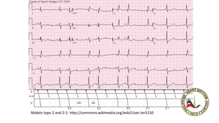 Mobitz type 2 and 2:1: http://commons.wikimedia.org/wiki/User:Jer5150
 