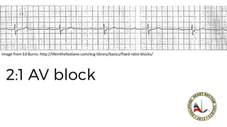 Image from Ed Burns: http://lifeinthefastlane.com/ecg-library/basics/fixed-ratio-blocks/
 
