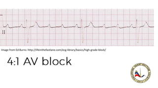 Image from Ed Burns: http://lifeinthefastlane.com/ecg-library/basics/high-grade-block/
 