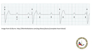 Image from Ed Burns: http://lifeinthefastlane.com/ecg-library/basics/complete-heart-block/
 