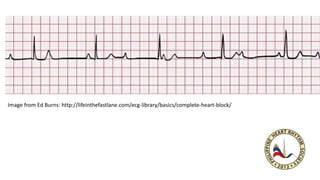 Image from Ed Burns: http://lifeinthefastlane.com/ecg-library/basics/complete-heart-block/
 