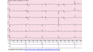 Complete heart block: http://commons.wikimedia.org/wiki/User:Jer5150
 