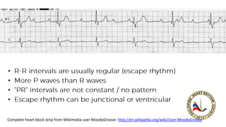 •
•
•
•
Complete heart block strip from Wikimedia user MoodyGroove: http://en.wikipedia.org/wiki/User:MoodyGroove
 