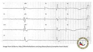 Image from Ed Burns: http://lifeinthefastlane.com/ecg-library/basics/complete-heart-block/
 