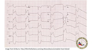 Image from Ed Burns: http://lifeinthefastlane.com/ecg-library/basics/complete-heart-block/
 