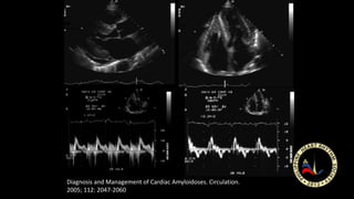 Diagnosis and Management of Cardiac Amyloidoses. Circulation.
2005; 112: 2047-2060
 