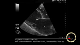 Image from wikimedia User Kalumet:
https://commons.wikimedia.org/wiki/File:Dilated_cardiomyopathy_B-Mode.jpg
 