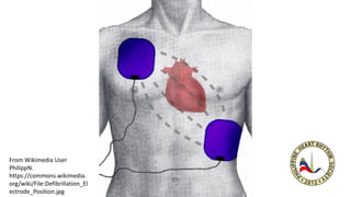 From Wikimedia User
PhilippN.
https://commons.wikimedia.
org/wiki/File:Defibrillation_El
ectrode_Position.jpg
 