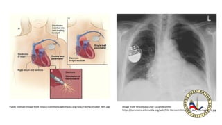Public Domain image from https://commons.wikimedia.org/wiki/File:Pacemaker_NIH.jpg Image from Wikimedia User Lucien Monfils:
https://commons.wikimedia.org/wiki/File:Herzschrittmacher_auf_Roentgenbild.jpg
 