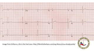 Image from Ed Burns, Life in the Fast Lane: http://lifeinthefastlane.com/ecg-library/sinus-bradycardia/
 