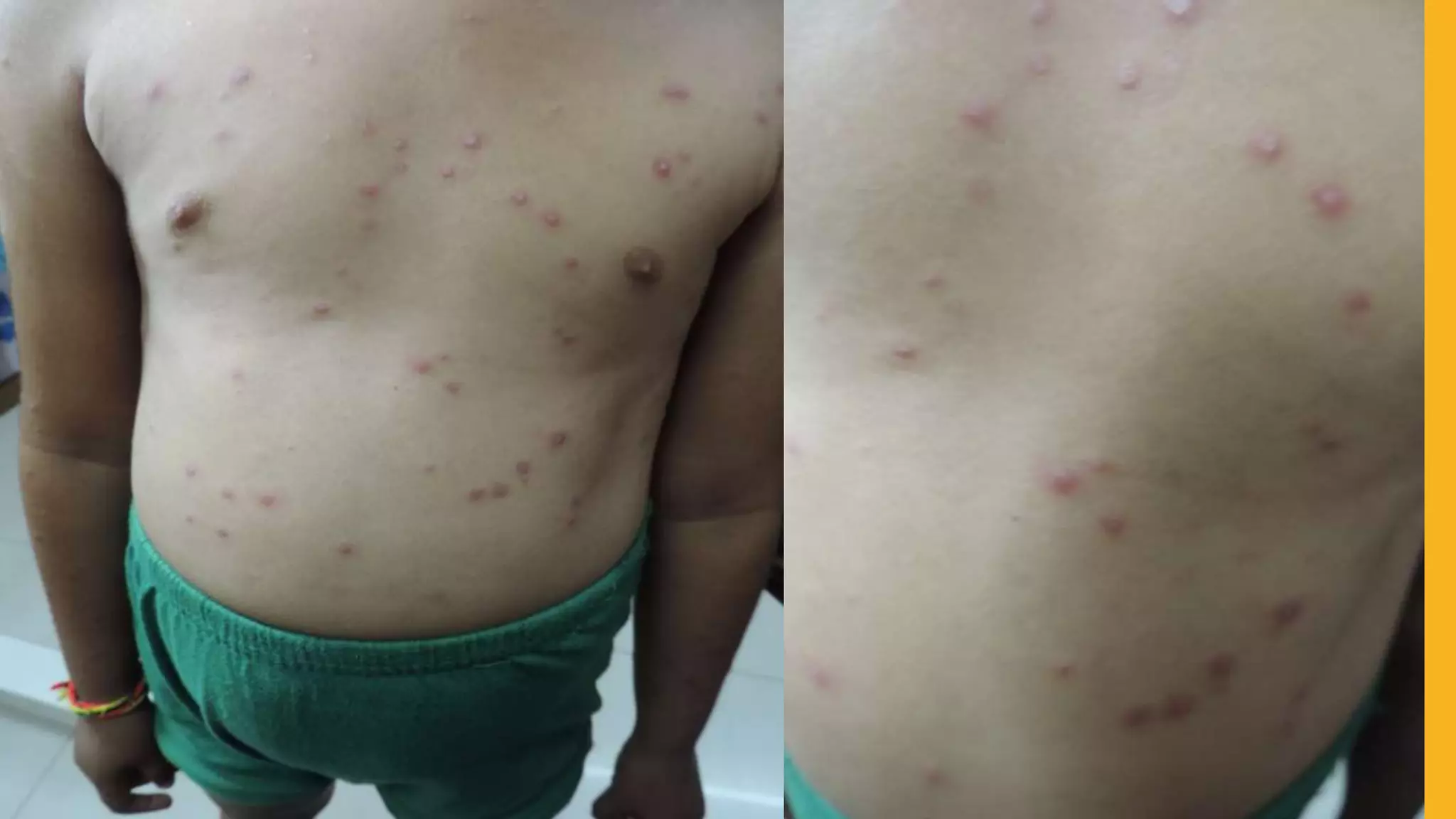 pustular granuloma annulare.pptx