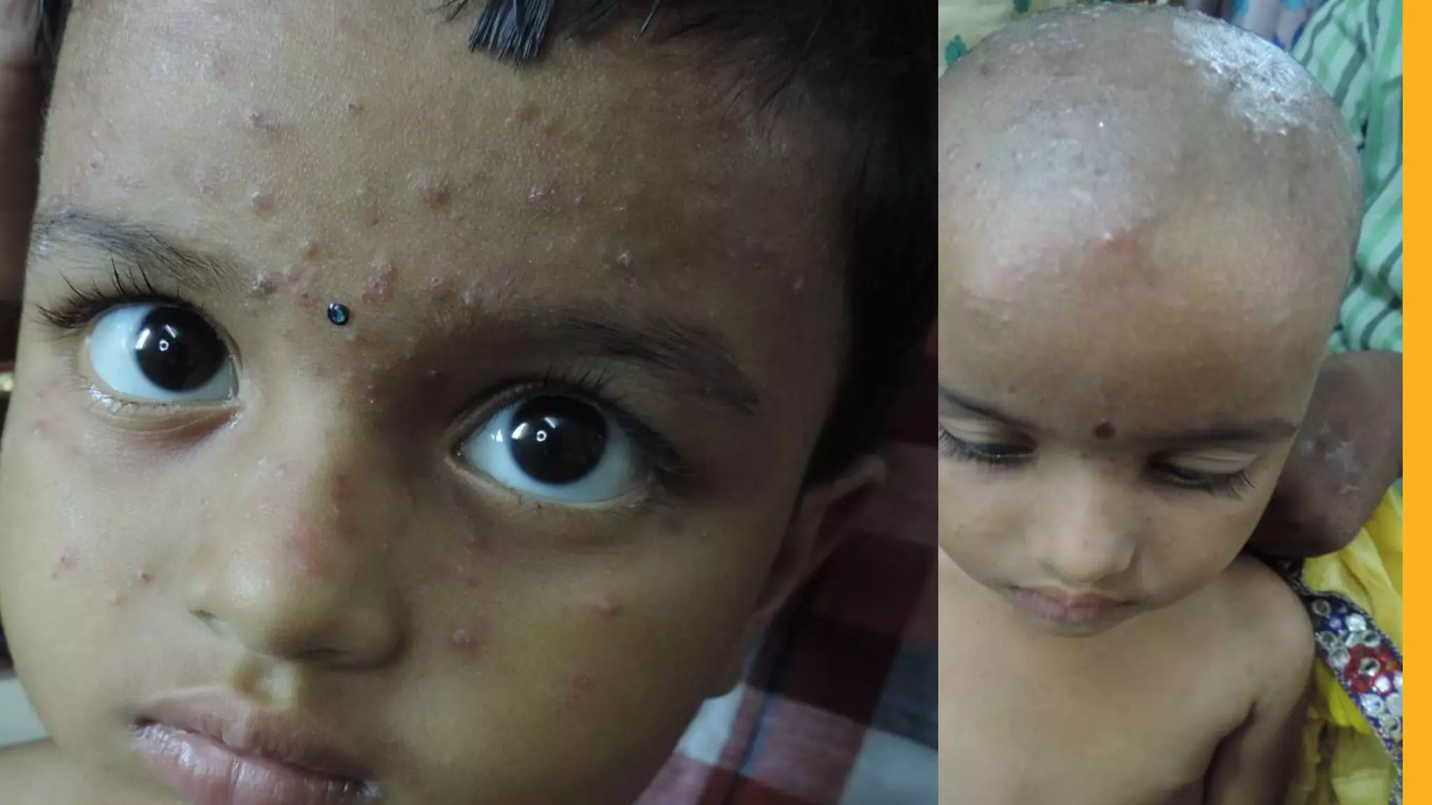 pustular granuloma annulare.pptx