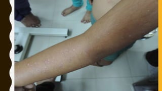 pustular granuloma annulare.pptx