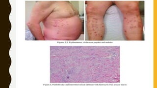 pustular granuloma annulare.pptx