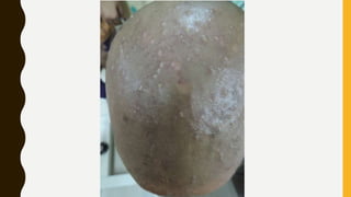 pustular granuloma annulare.pptx