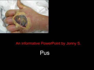 An informative PowerPoint by Jonny S. Pus              Pus 
