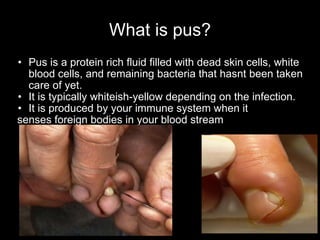 Pus v2 | PPT