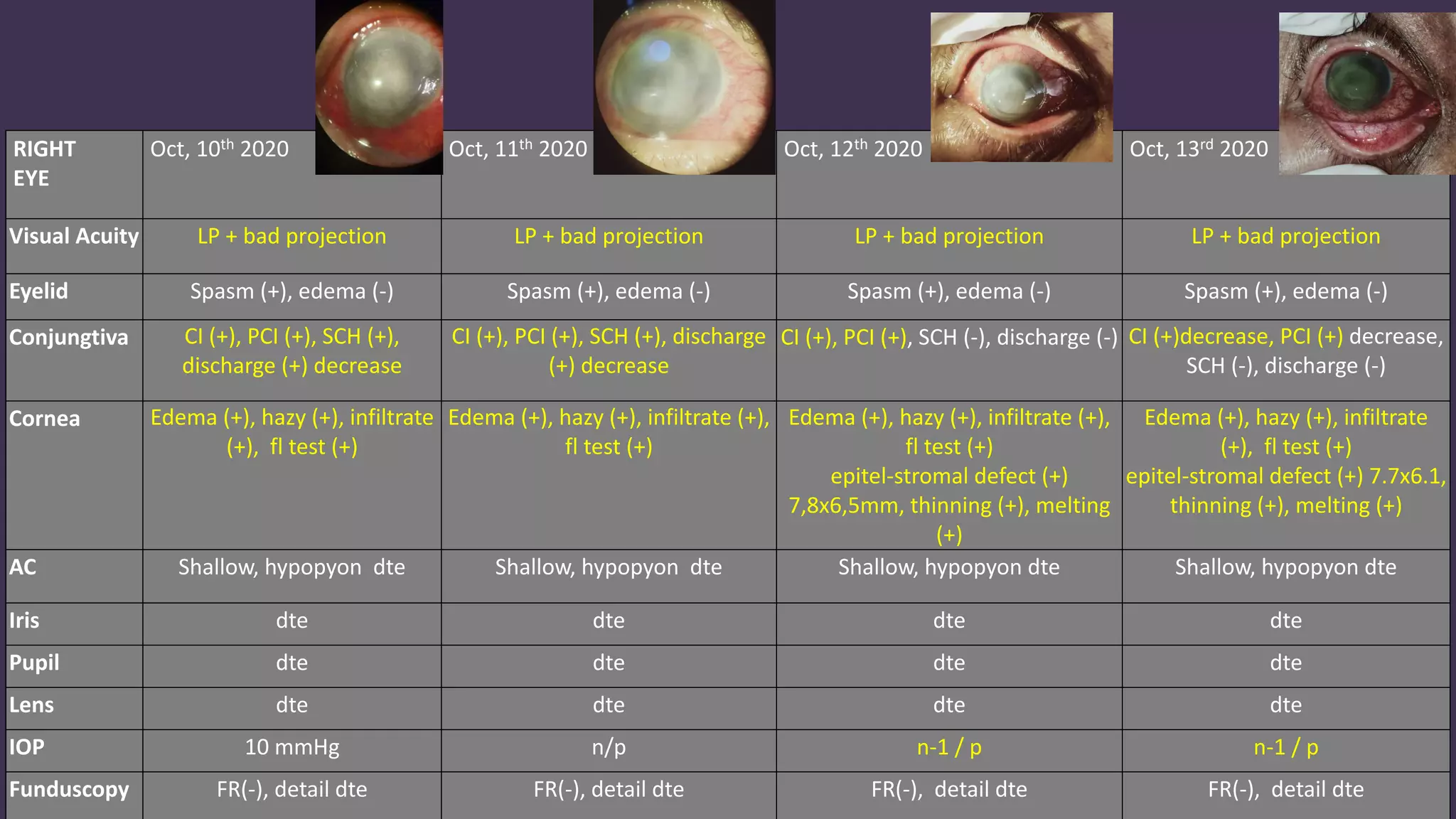 Acute Post Operative Endophthalmitis (Pseudomonas aeruginosa MDR) | PDF