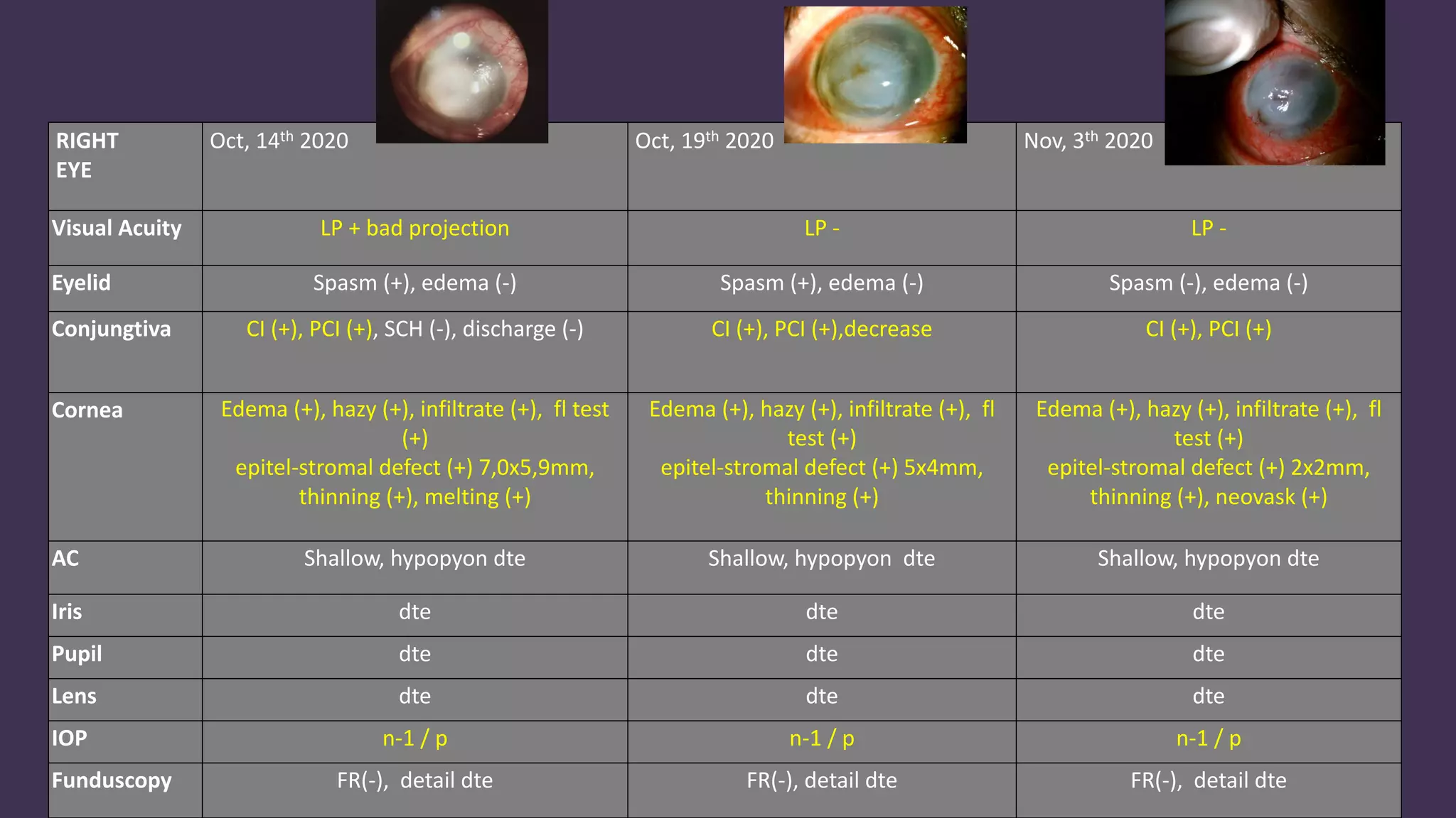 Acute Post Operative Endophthalmitis (Pseudomonas aeruginosa MDR) | PDF