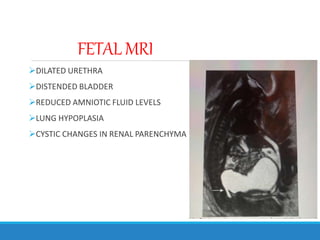 FETAL MRI
DILATED URETHRA
DISTENDED BLADDER
REDUCED AMNIOTIC FLUID LEVELS
LUNG HYPOPLASIA
CYSTIC CHANGES IN RENAL PARENCHYMA
 